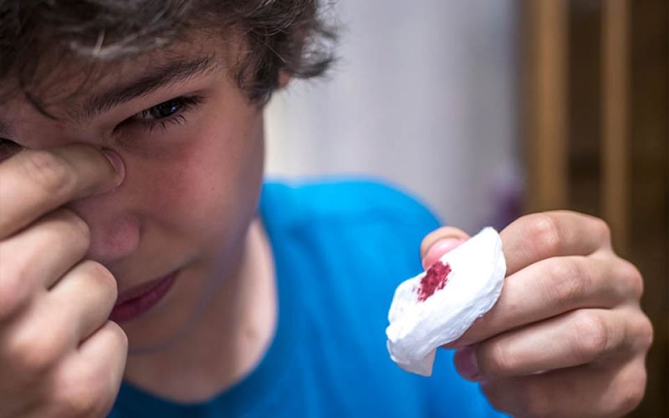 Sangrado Nasal | Dr. Jesús Avelar, Otorrinolaringología Pediátrica