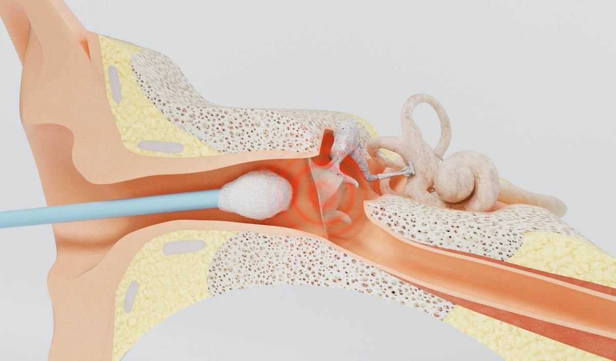 Dr. Jesús Avelar | Perforación del Tímpano