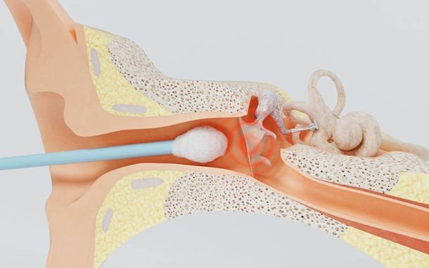 Dr. Jesús Avelar | Perforación de Tímpano